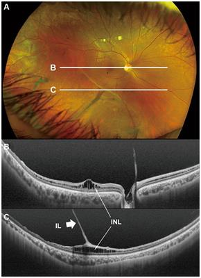 Optical coherence tomography findings of the peripheral retina in patients with congenital X-linked retinoschisis